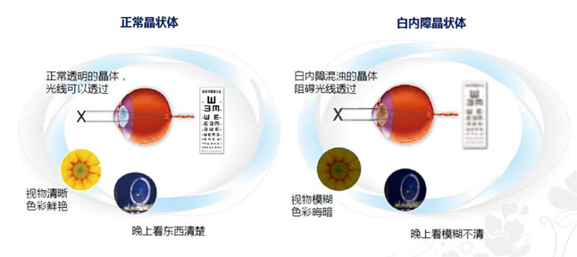 白內障和老花眼區(qū)別