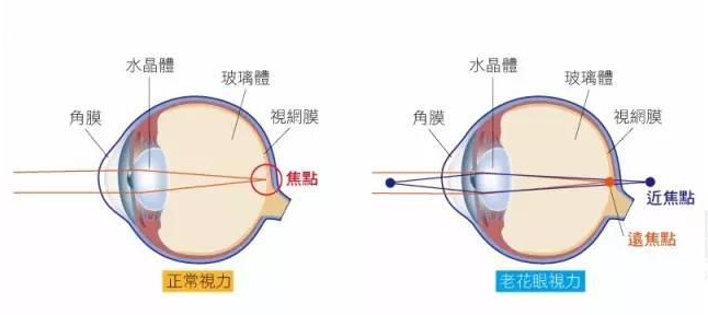 500度近視又老花，戴上美麗島多焦鏡煩惱全解決，46歲的周先生樂壞了